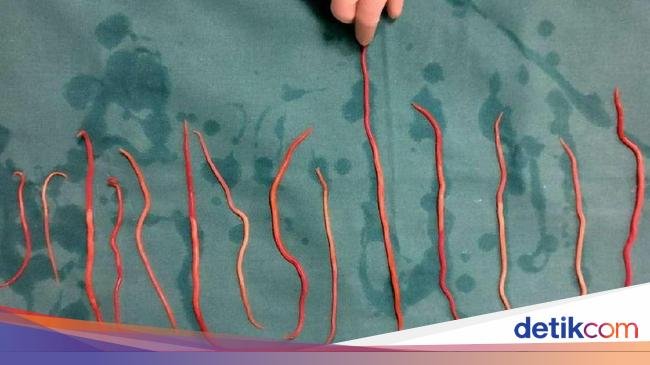Penjelasan RS Mengenai Cacing di Tubuh Raya Sukabumi yang Berujung pada Kematian